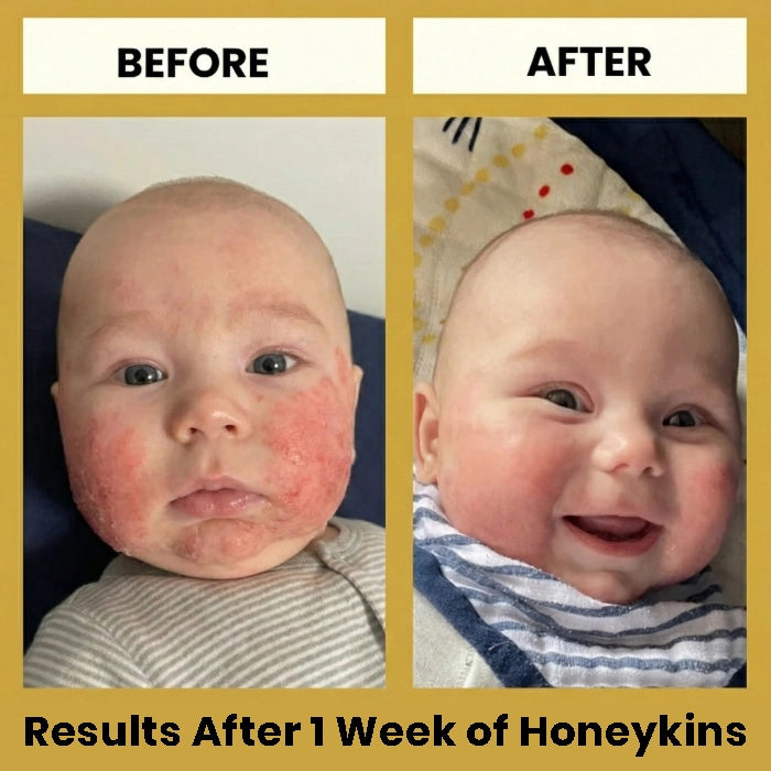 Honeykins™ Eczema Cream