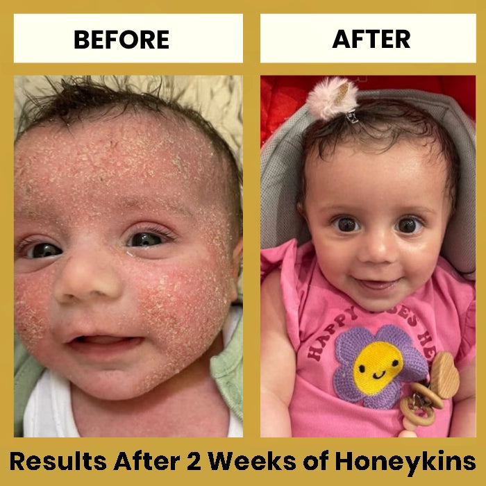 Honeykins™ Eczema Cream