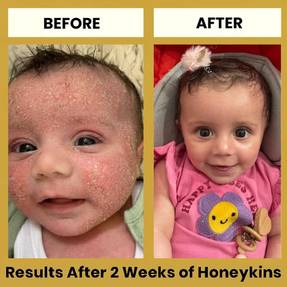 Honeykins™ Eczema Cream