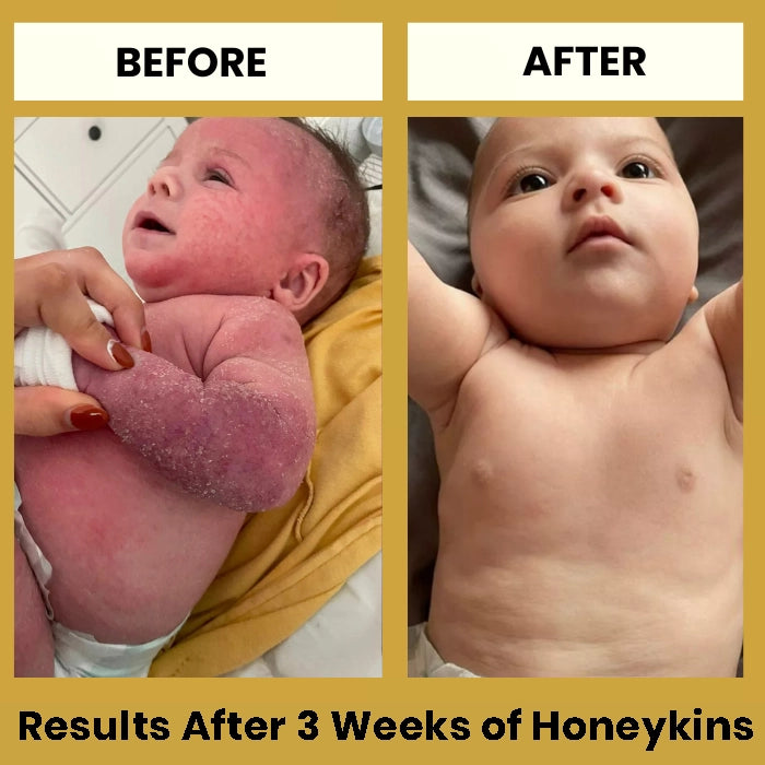 Honeykins™ Eczema Cream